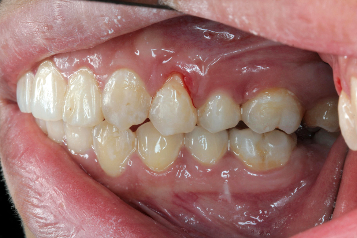 Gum Bleeding / Recession (Left Side View)